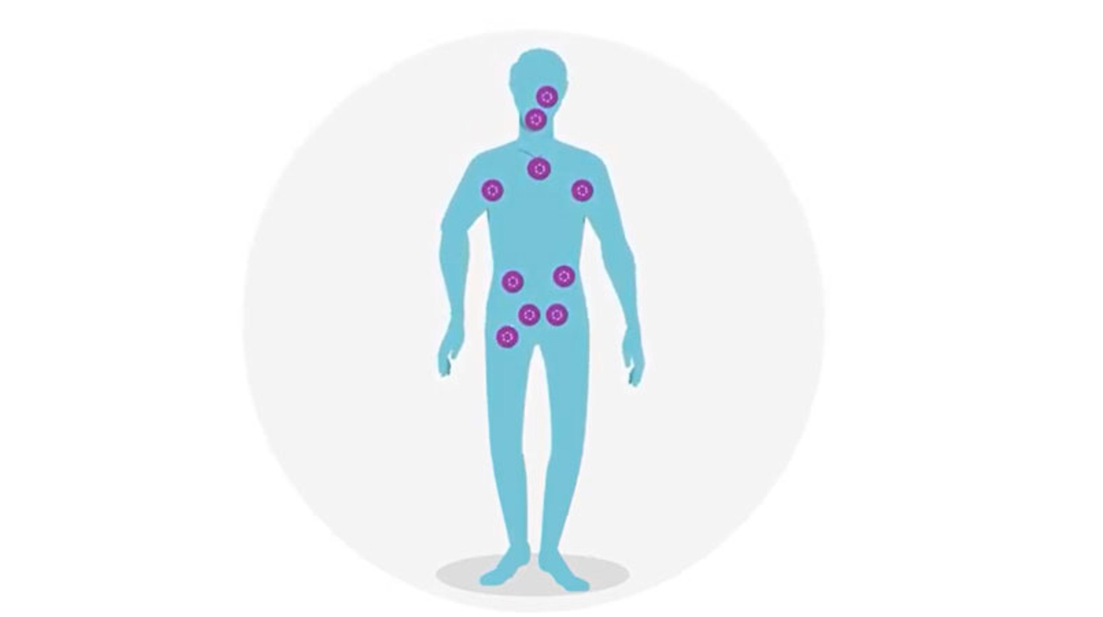 Next-generation cancer treatment: Patient stratification with immuno-oncology Next-generation cancer treatment: Patient stratification with immuno-oncology