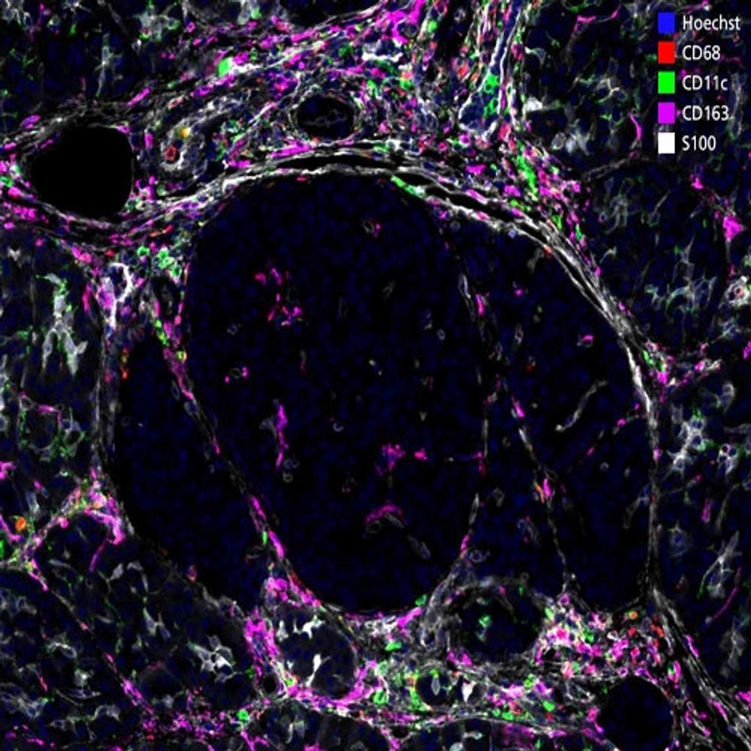 Type 1 Diabetes sample stained with Orion Biomarkers