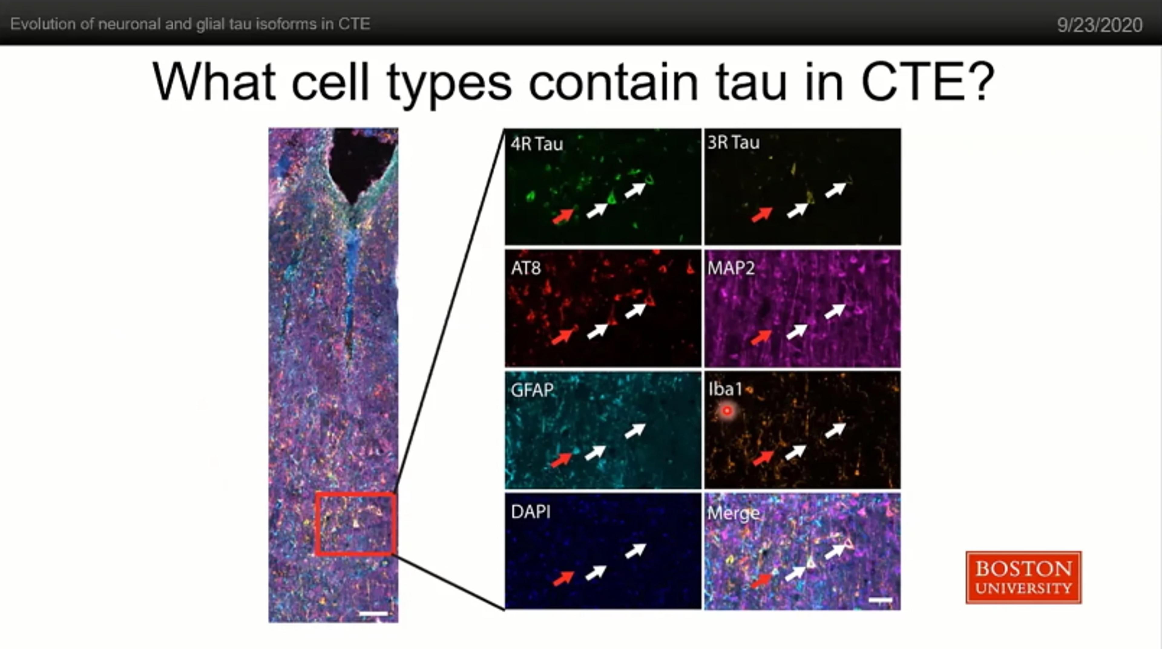 Evolution of neuronal and glial tau isoforms in Chronic Traumatic Encephalopathy (CTE)