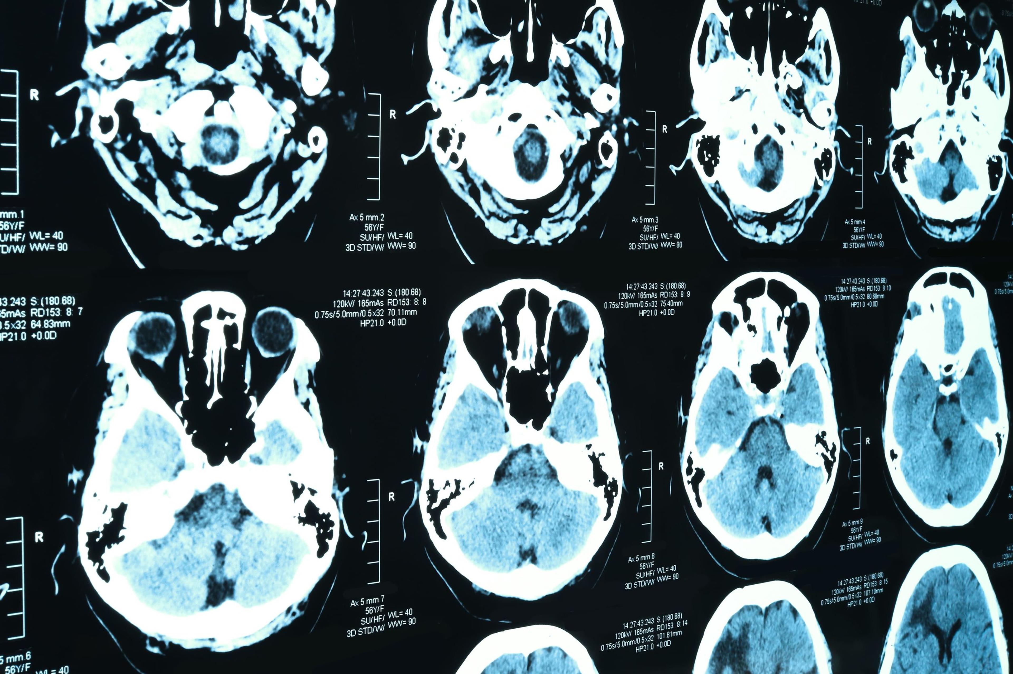 Computerized tomography of the brain (CT scan)