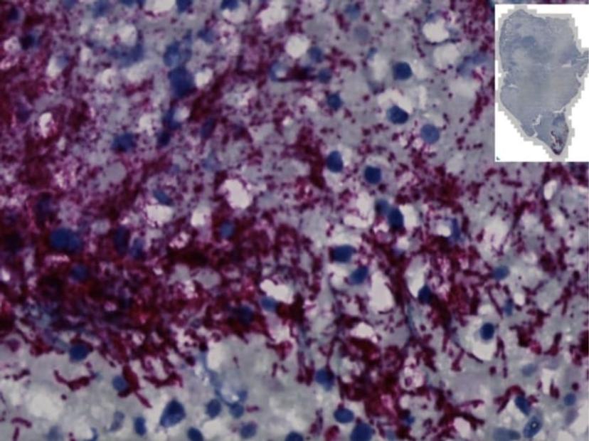 A Microscope image showing a human colorectal cancer tumor with Fusobacterium nucleatum stained in a red-purple color