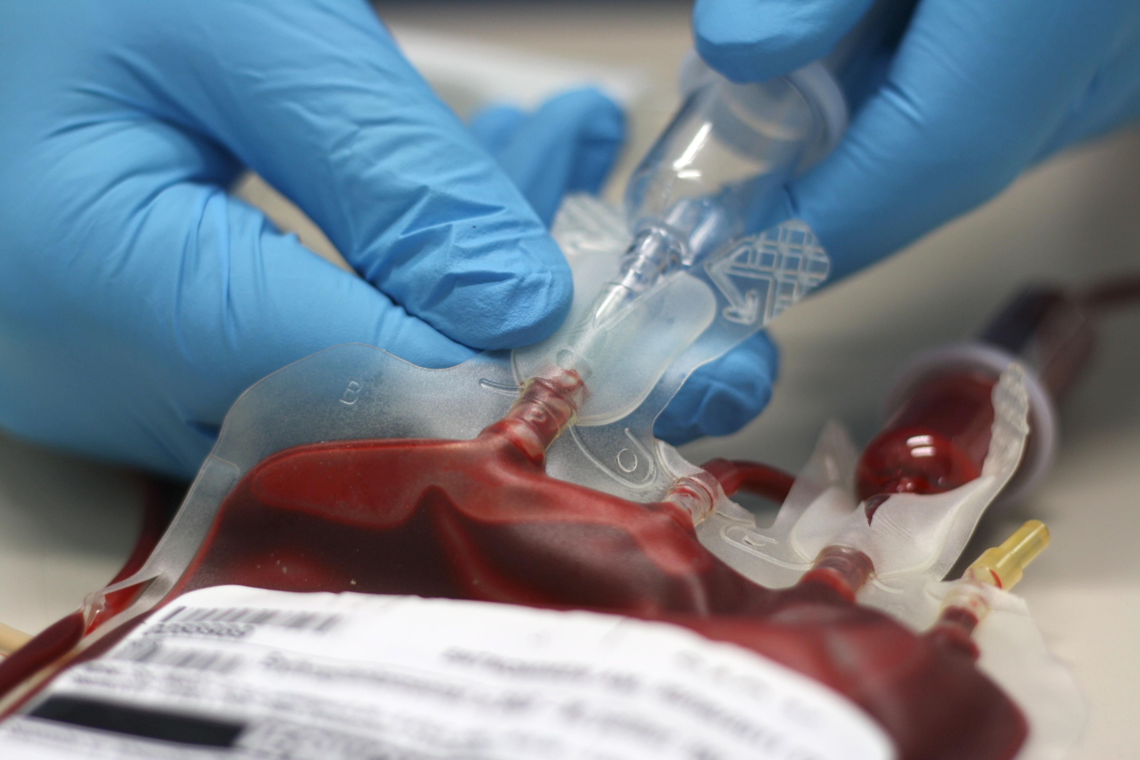 A bag of donor blood prepared for transfusion