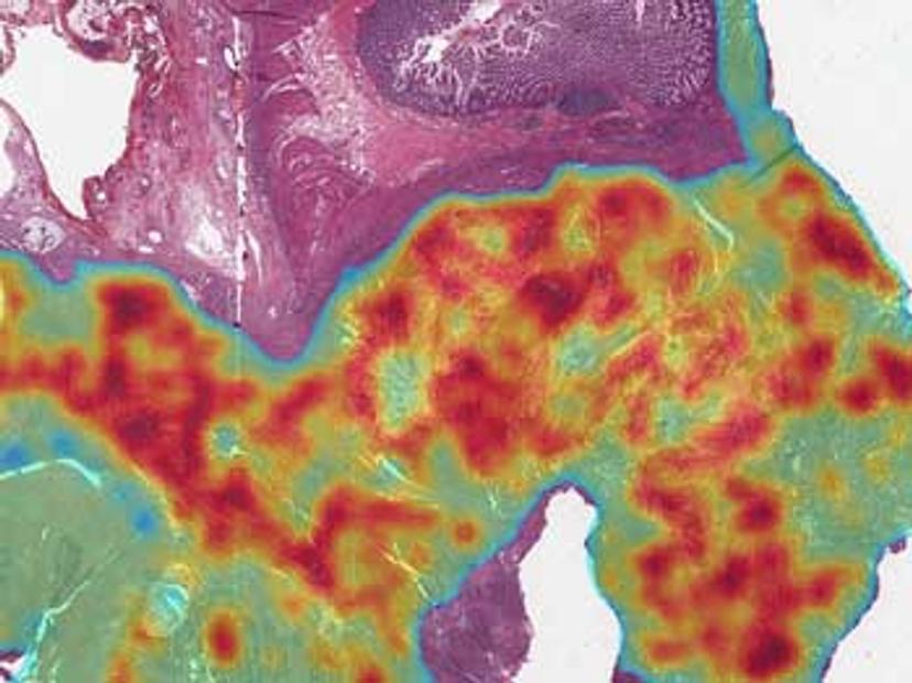 Spatial map of a colorectal cancer tissue section