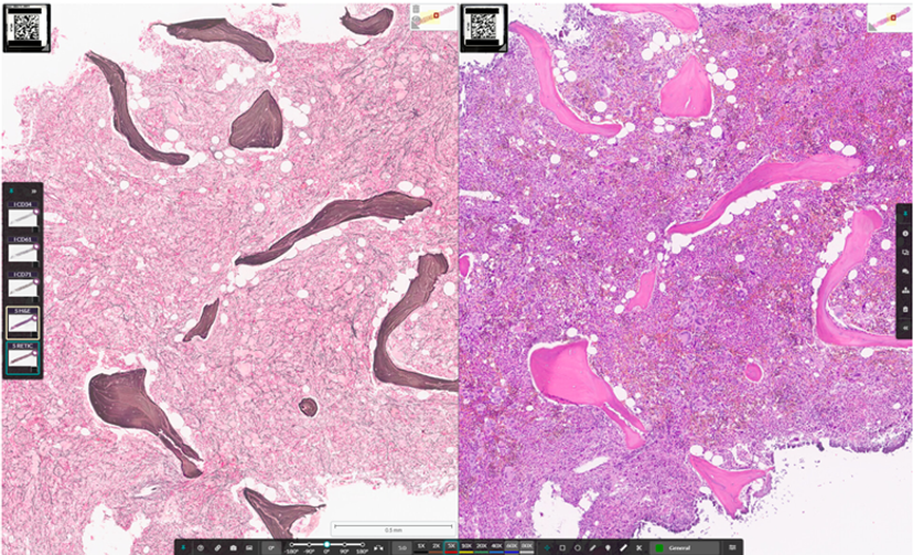 Myelofibrosis case with reticulin staining (left) and H&E (right)