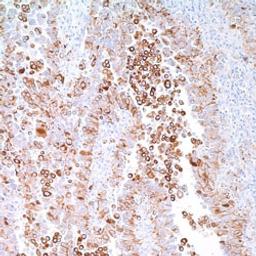 Cytokeratin 5 & 6 (D5 & 16B4) on mesothelioma cells