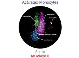 Monocyte Distribution Width Severity of Infection Biomarker