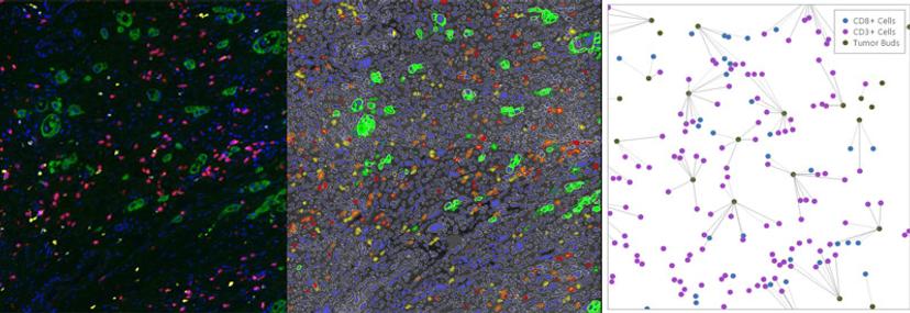 Three images of stained tumor cells, CD3 cells and CD8 cells