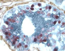 Breast Carcinoma (triple label)