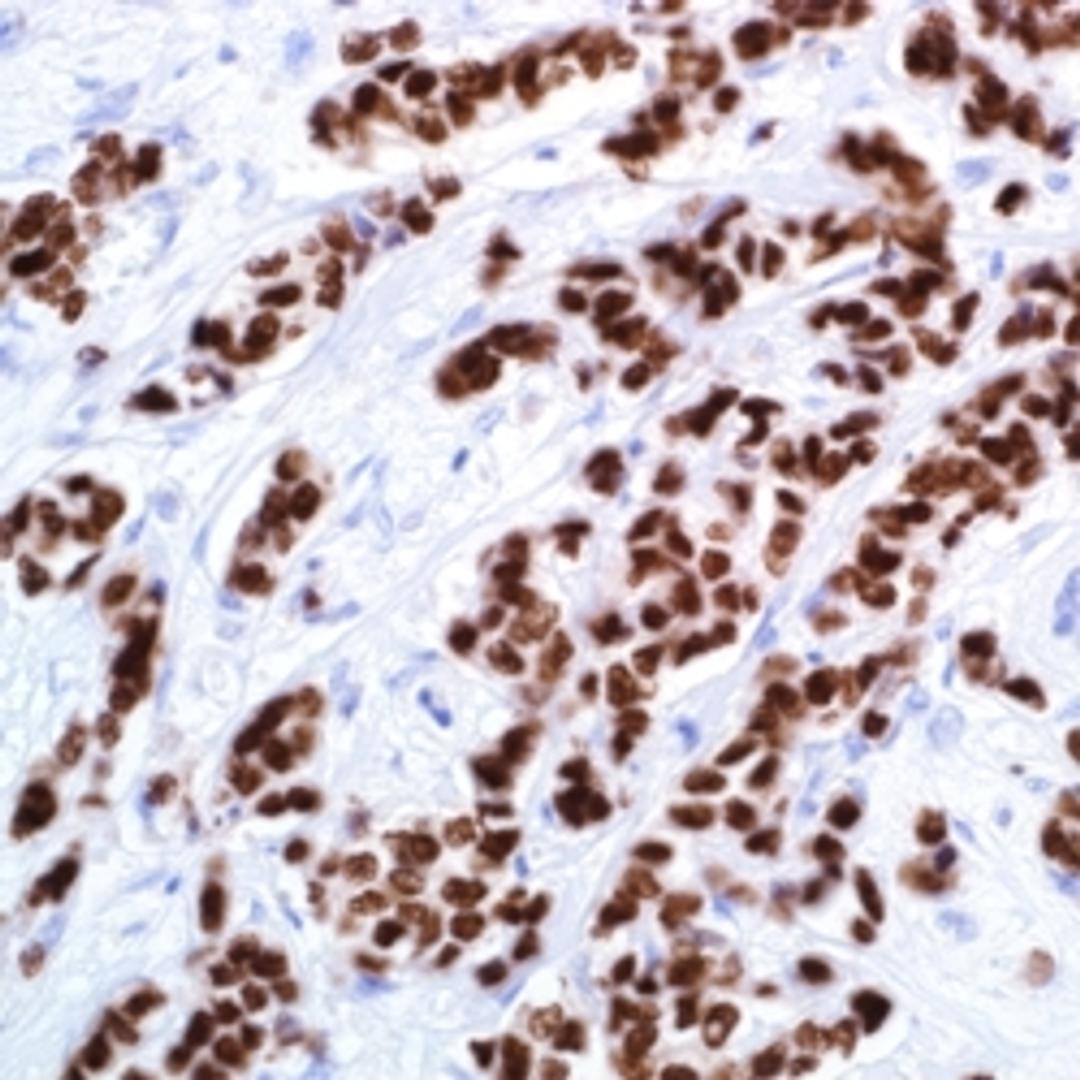 GATA3 (L50-823) on breast, invasive ductal carcinoma.