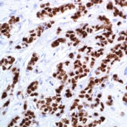 GATA3 (L50-823) on breast, invasive ductal carcinoma.