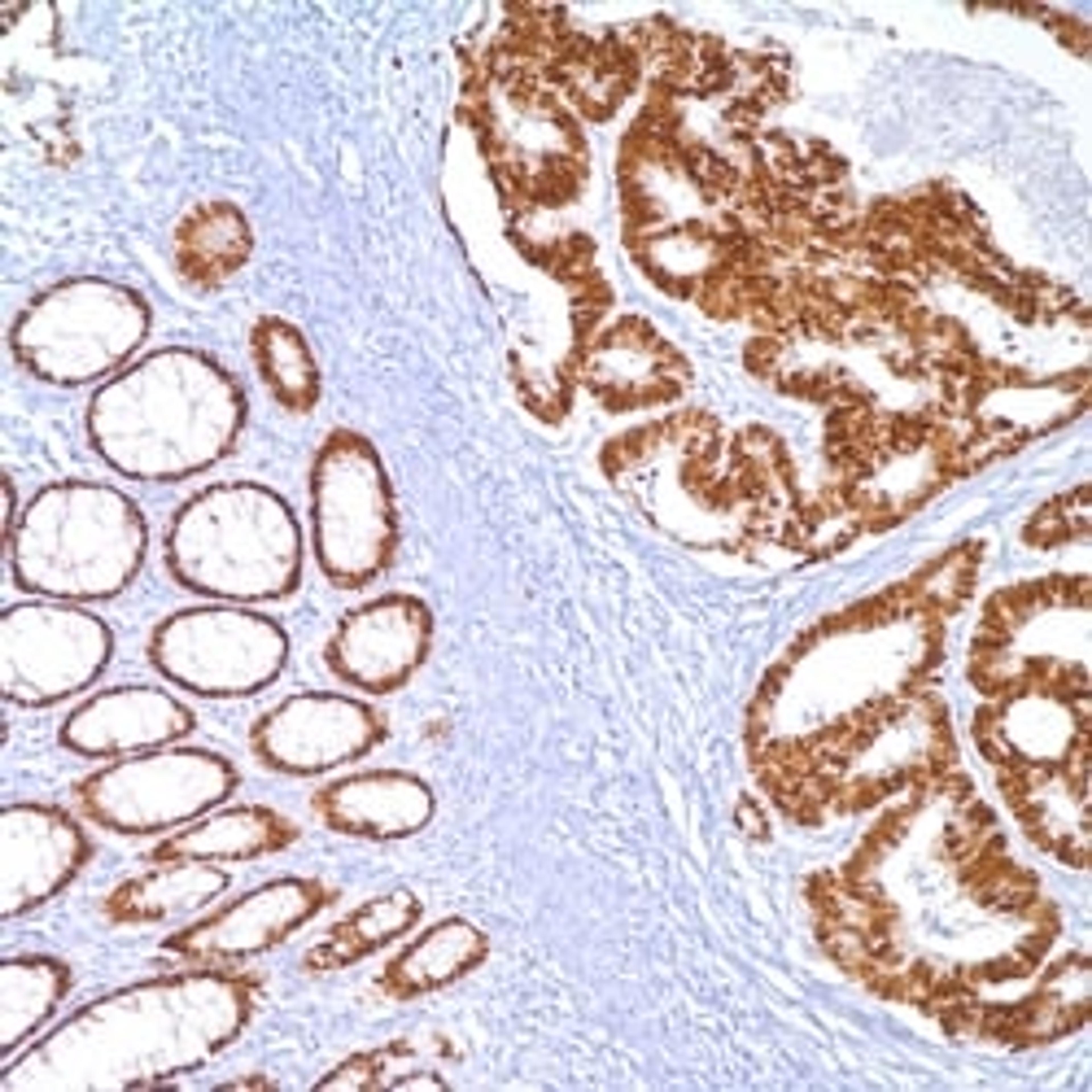 CDX-2 (EPR2764Y) on colon adenocarcinoma.