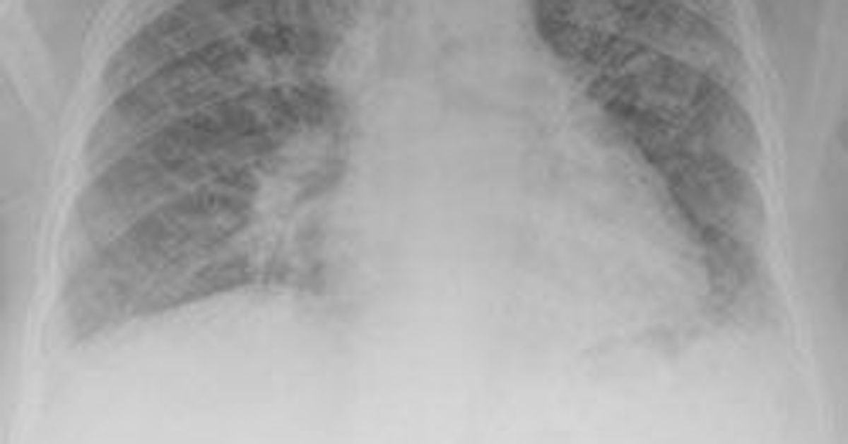 New MicroarrayonaChip Test for Cystic Fibrosis