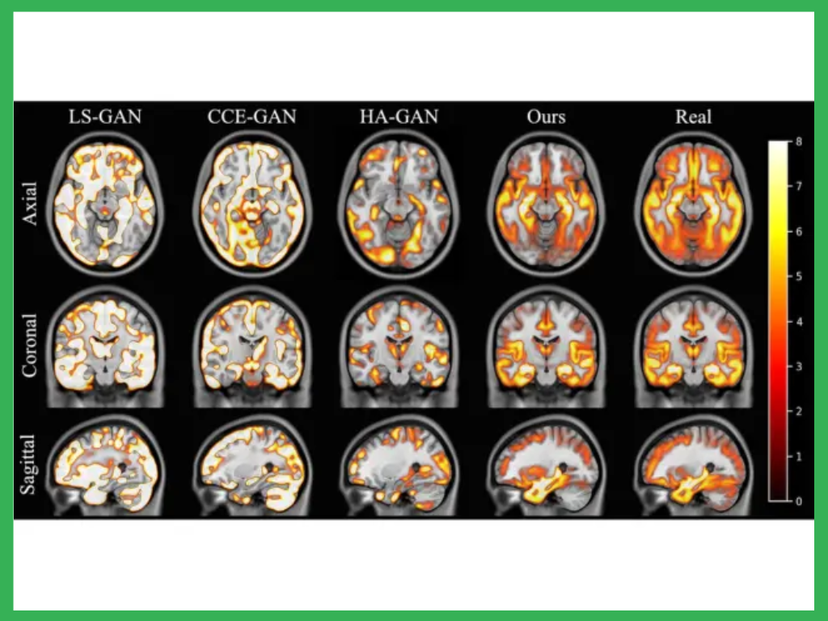 Image from study, showing areas of the brain affected by Alzheimer's disease in yellow