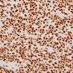 ATRX (polyclonal) on oligodendroglioma