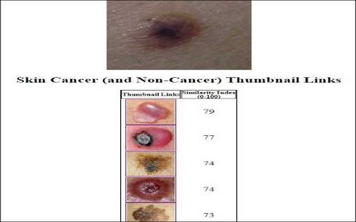 image for Skin Cancer Image Search