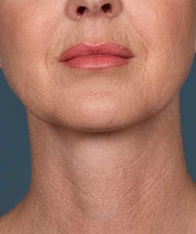 After the Fifth Avenue Lift — jawline and neck
