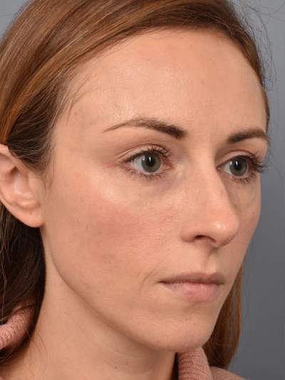 After laser treatment