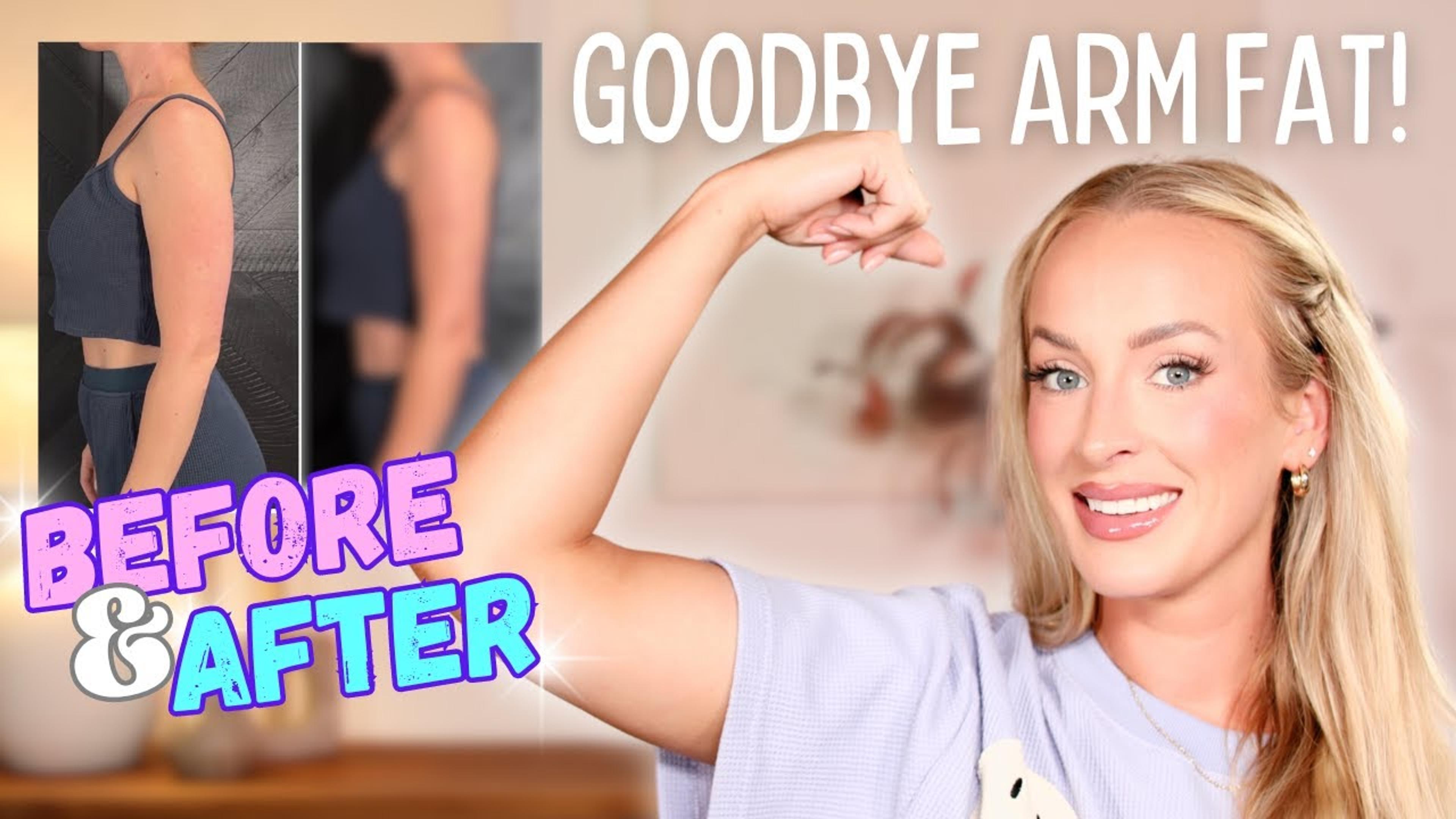 My Honest Arm Liposuction Journey: Surgery to Recovery