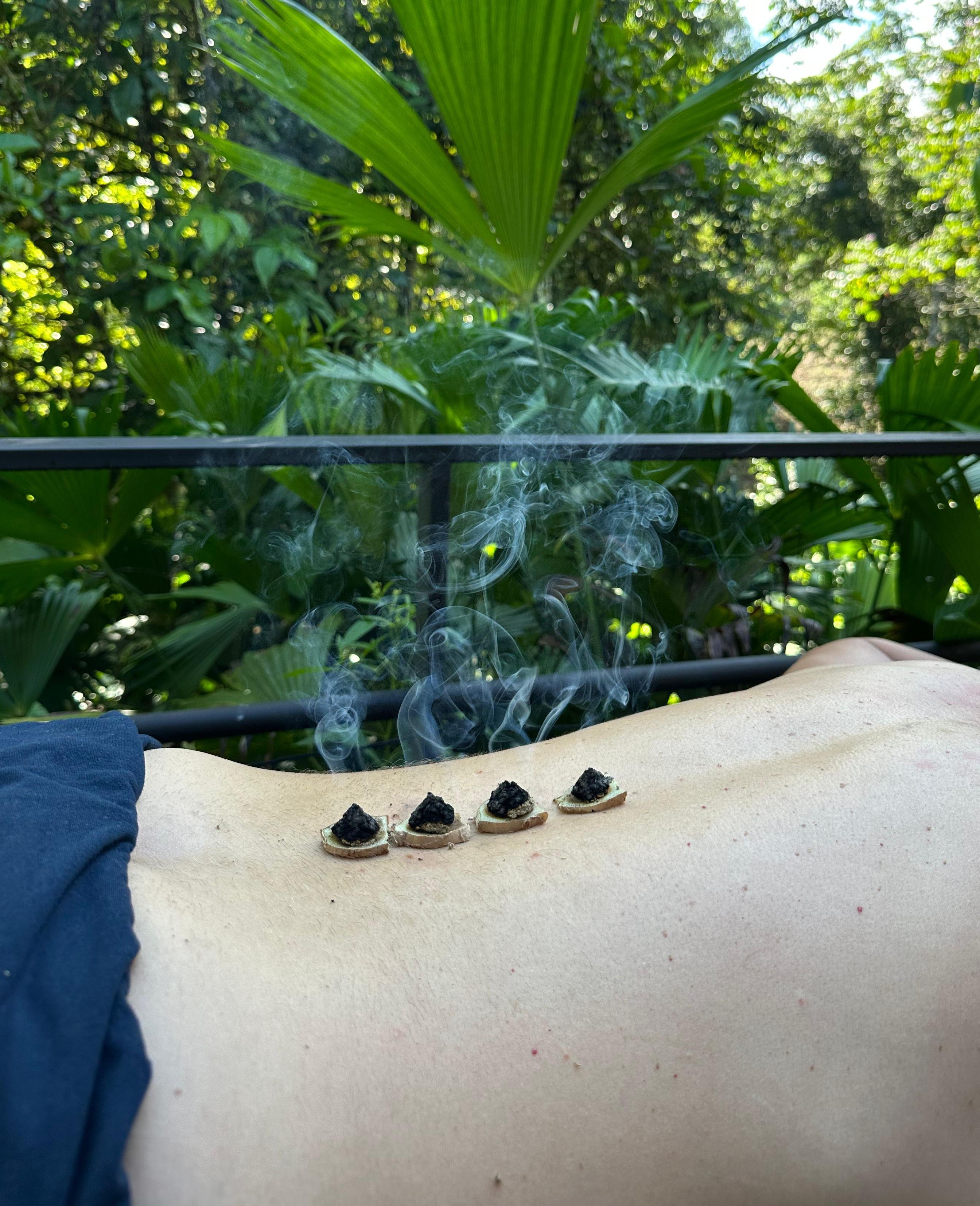 Moxa warming points on a client's back in the outdoor studio
