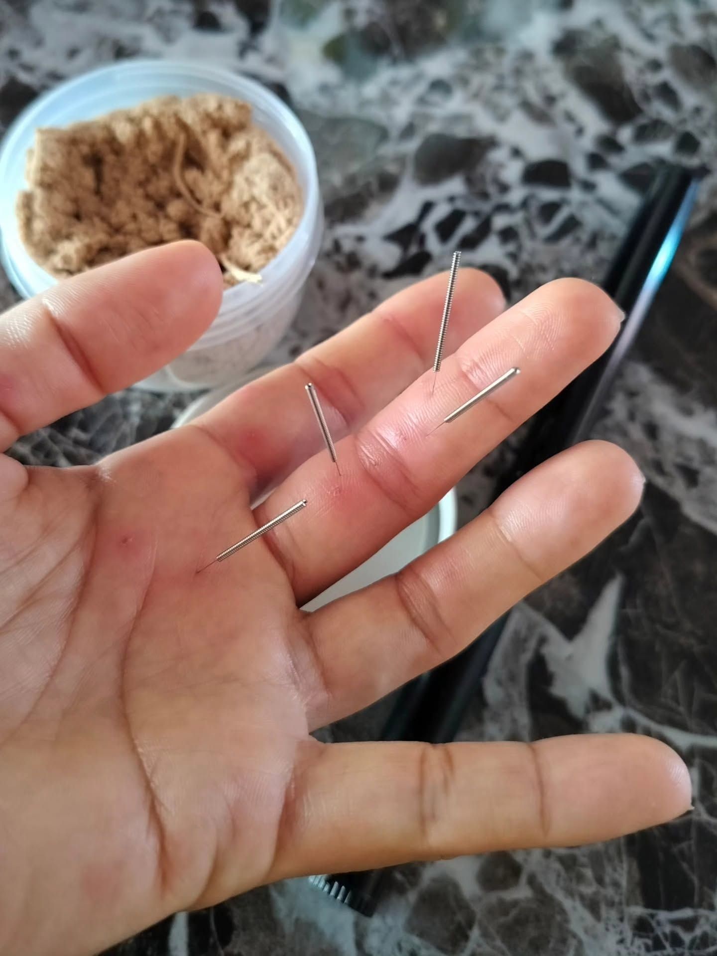 Fine acupuncture needles held in a practitioner's hand