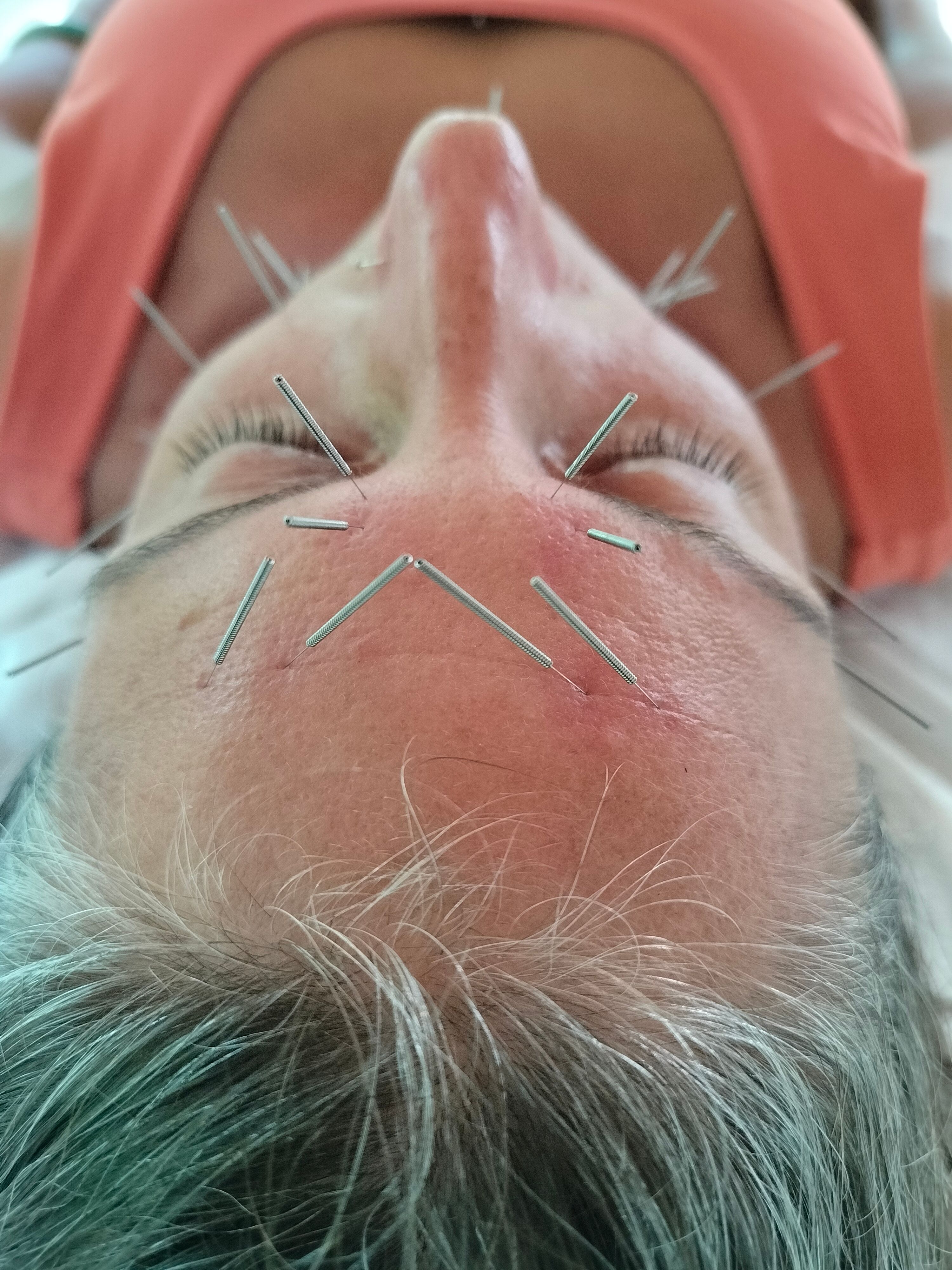 Fine acupuncture needles placed on a client's face