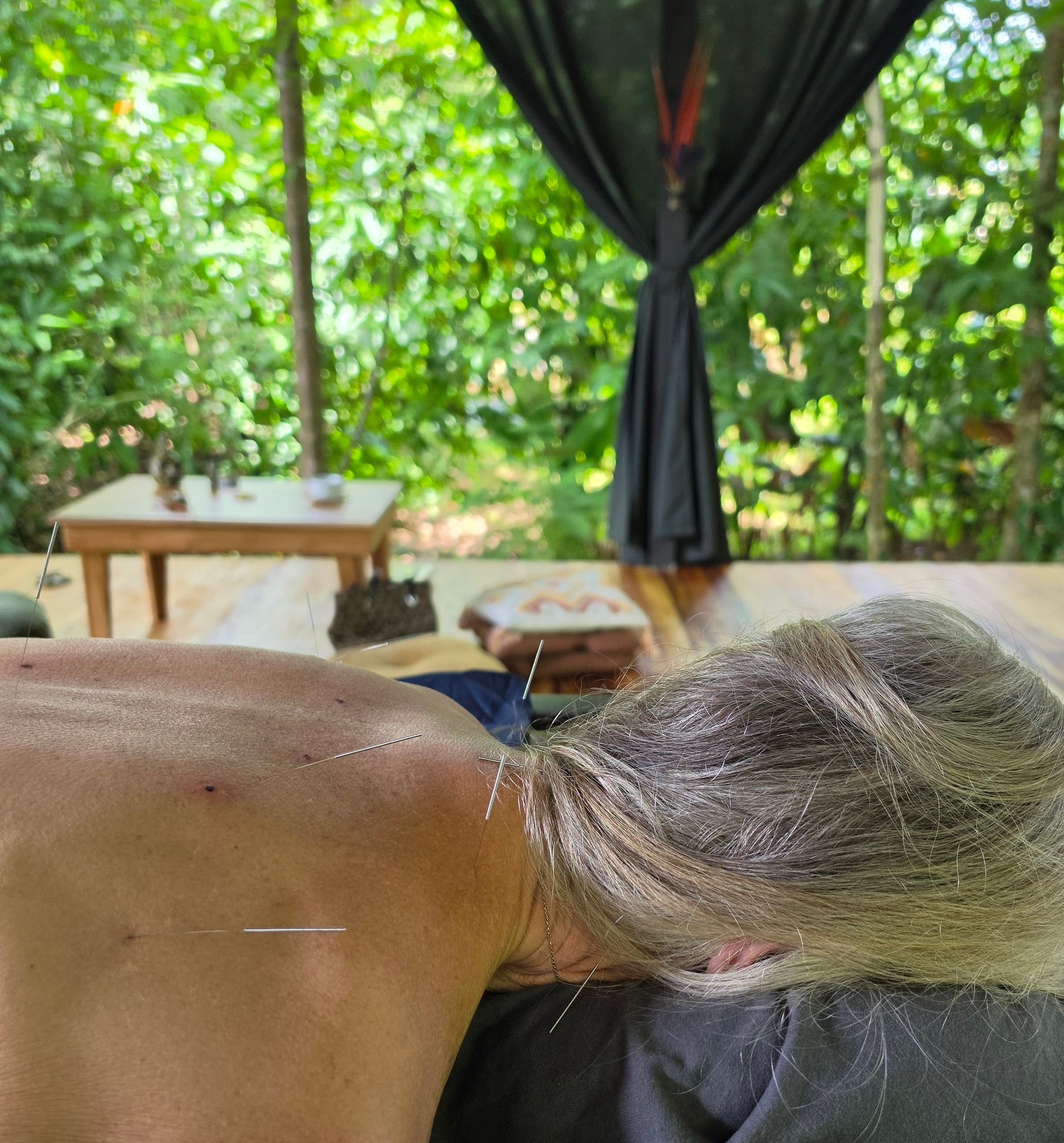 Moxa warming points on a client's back in the outdoor studio