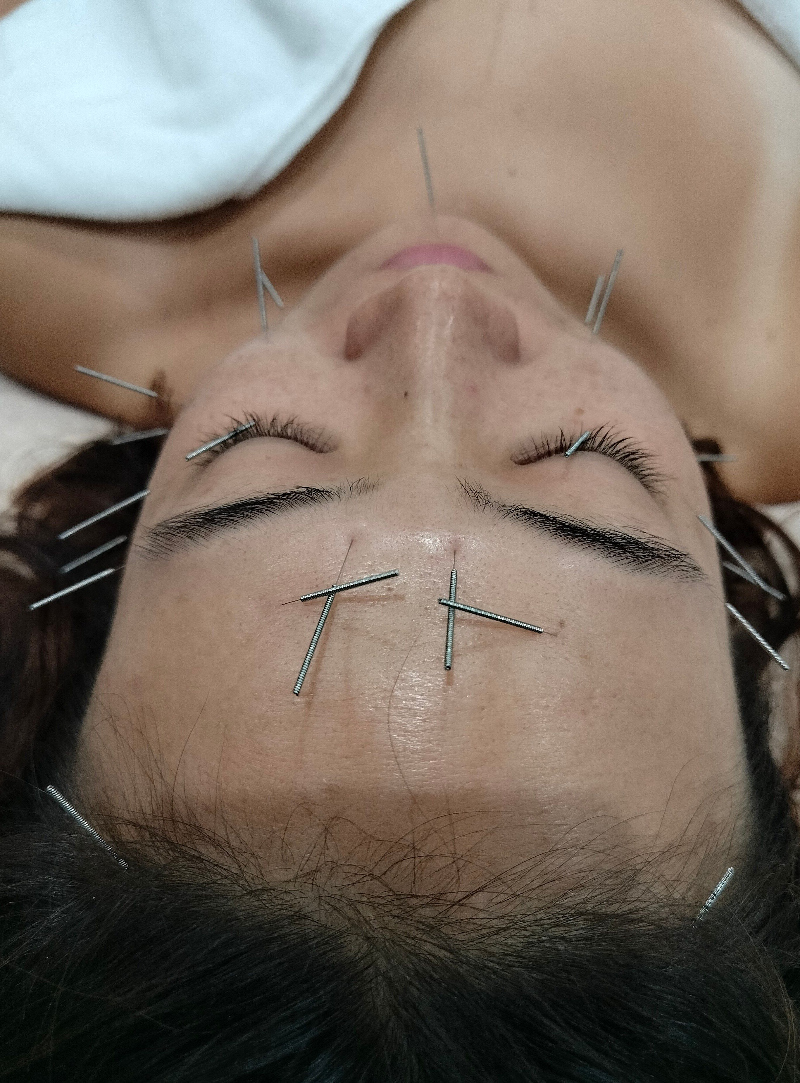 Fine acupuncture needles placed on a client's face