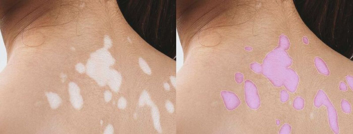 ai in dermatology