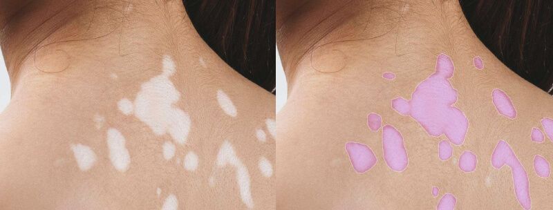 ai in dermatology