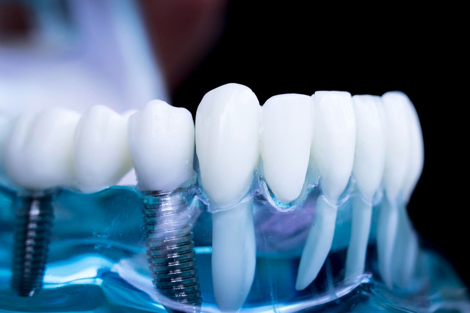 Protezy na implantach — jak wyglądają, ile kosztują i czy warto?