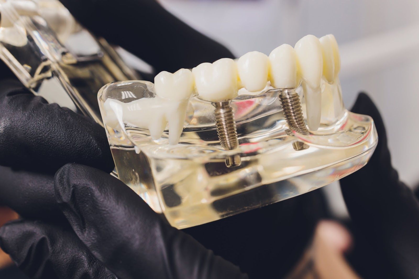 Obalamy 10 najczęstszych mitów o implantach zębowych – co warto wiedzieć?