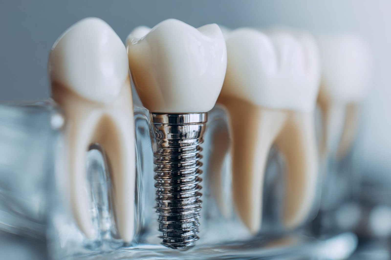 Zanik kości a implanty – czy można zrobić implant bez kości