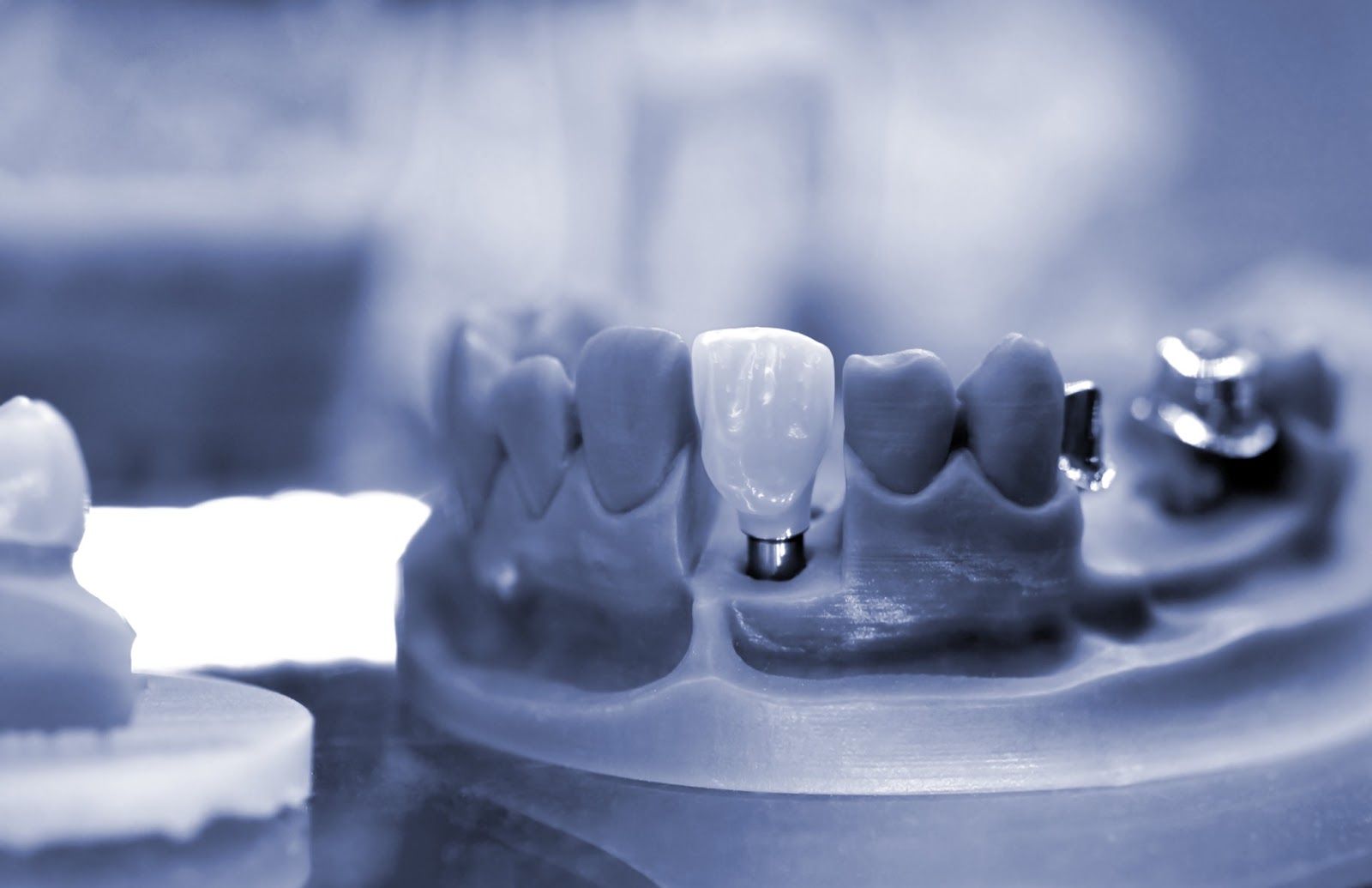 Codzienne życie z implantami: komfort, jedzenie i higiena po leczeniu implantologicznym