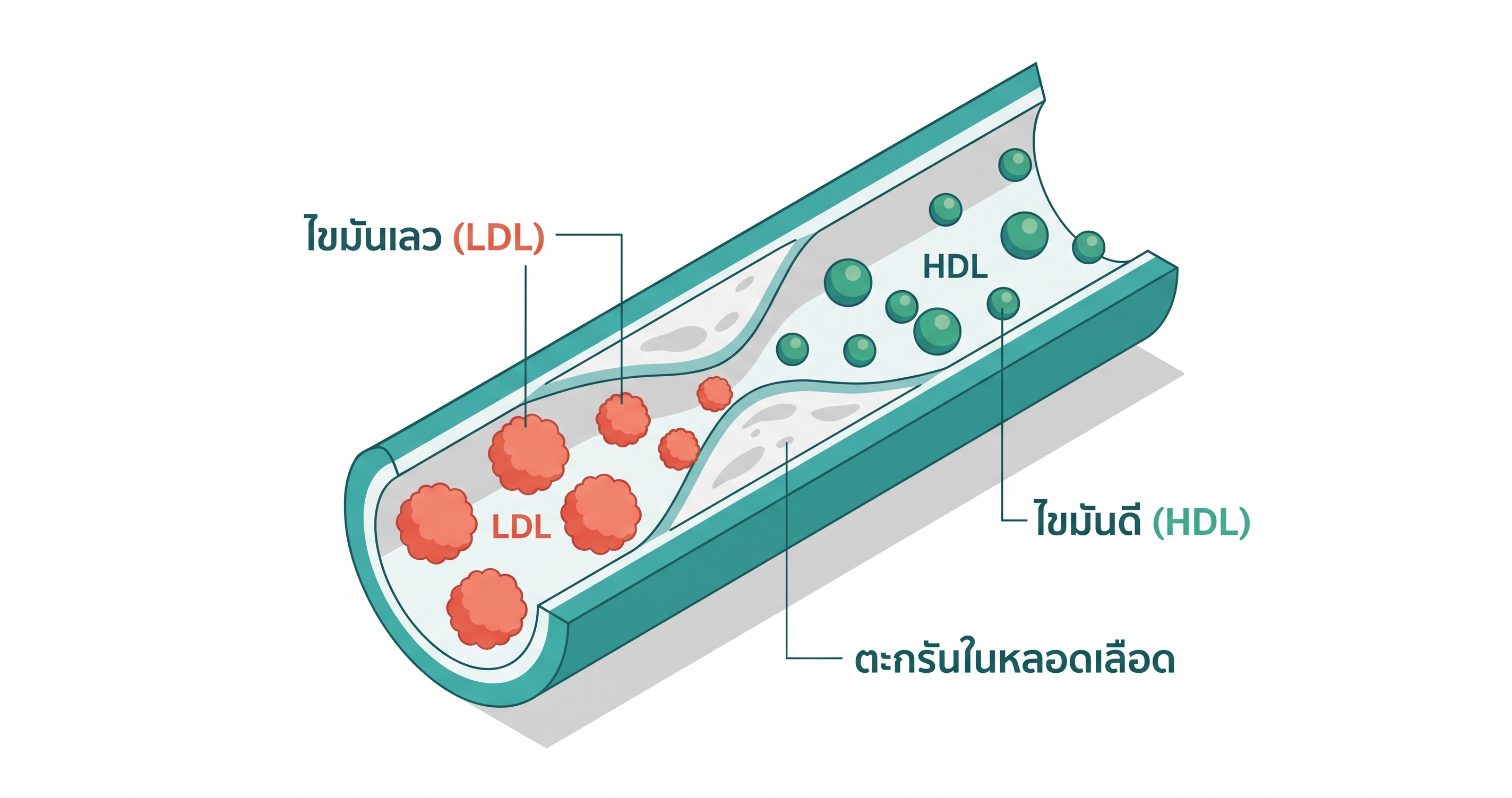 วิธีลด LDL ตามธรรมชาติ — infographic แสดงอนุภาค LDL และ HDL ในหลอดเลือด