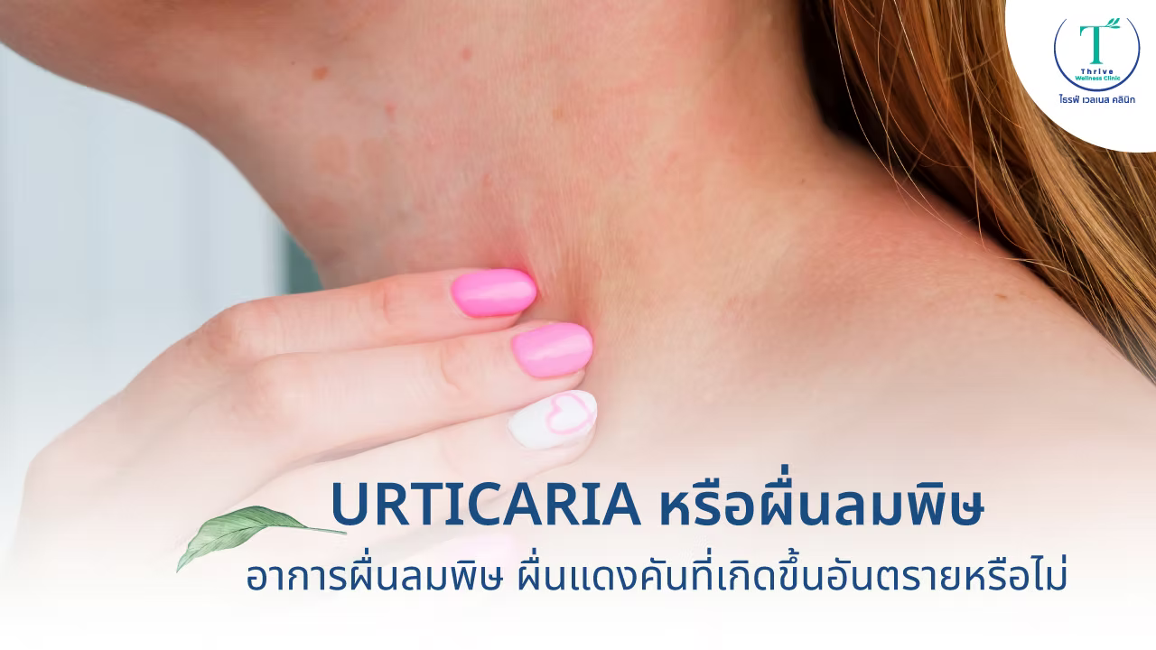 ผื่นลมพิษ ผื่นแดงที่แก้ไม่หายขาด เป็นทุกทีที่อากาศเปลี่ยน แก้ไขได้อย่างไร