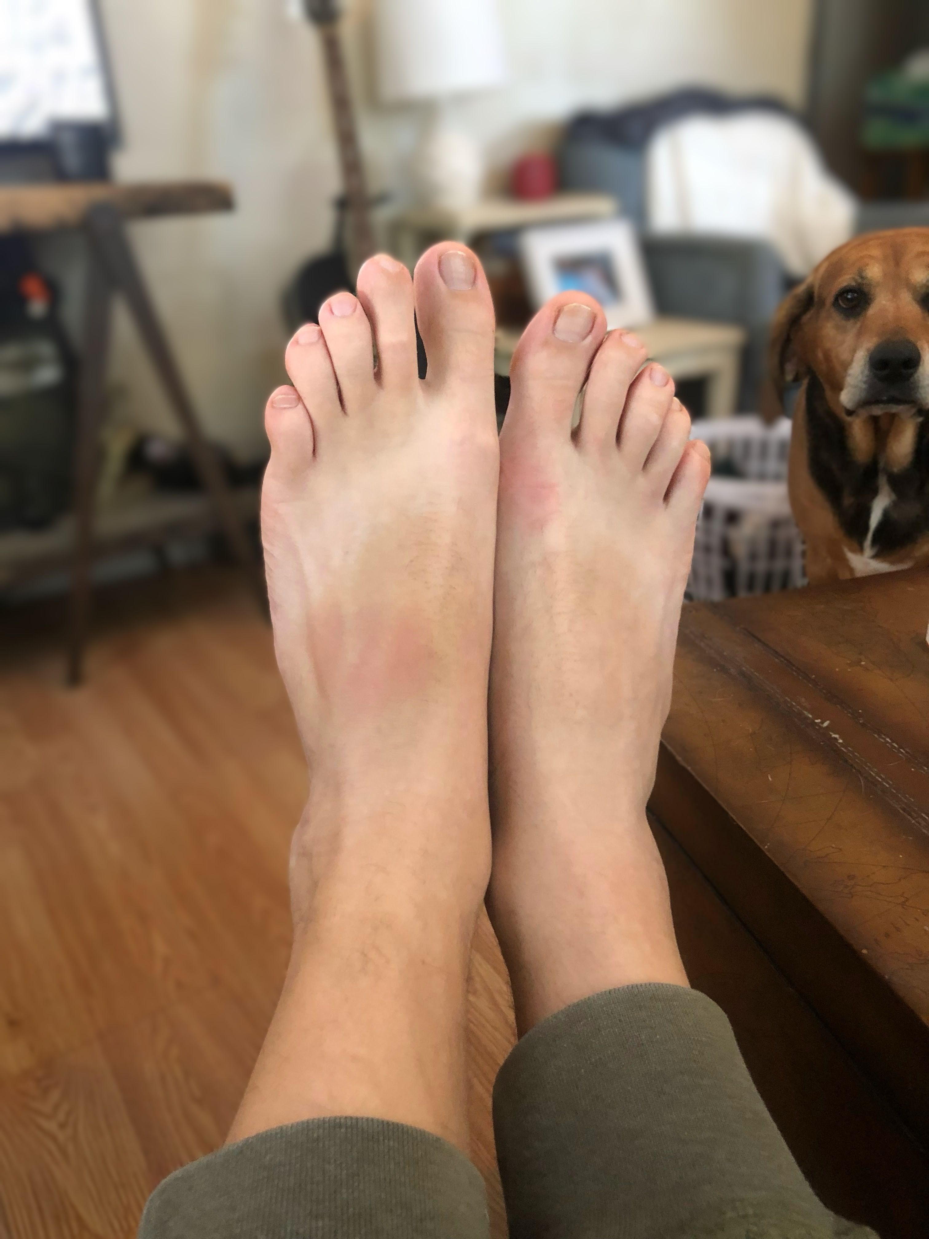 Benjamin Powell Photographs Left Foot Injury