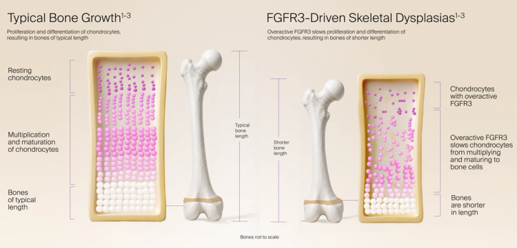 Comparison of average bone growth and FGFR3-driven skeletal dysplasias, where overactive FGFR3 slows chondrocyte growth
