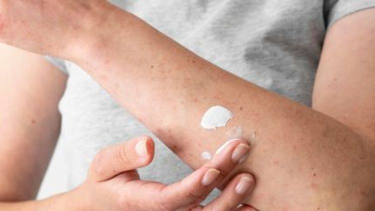 Las mejores cremas para la piel atópica ¿Cuáles utilizar?