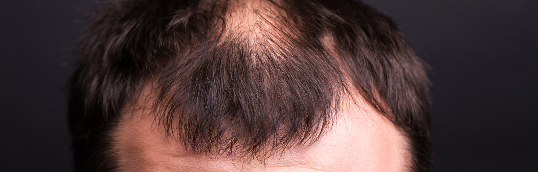 Alopecia areata: causas, síntomas y tratamiento a seguir