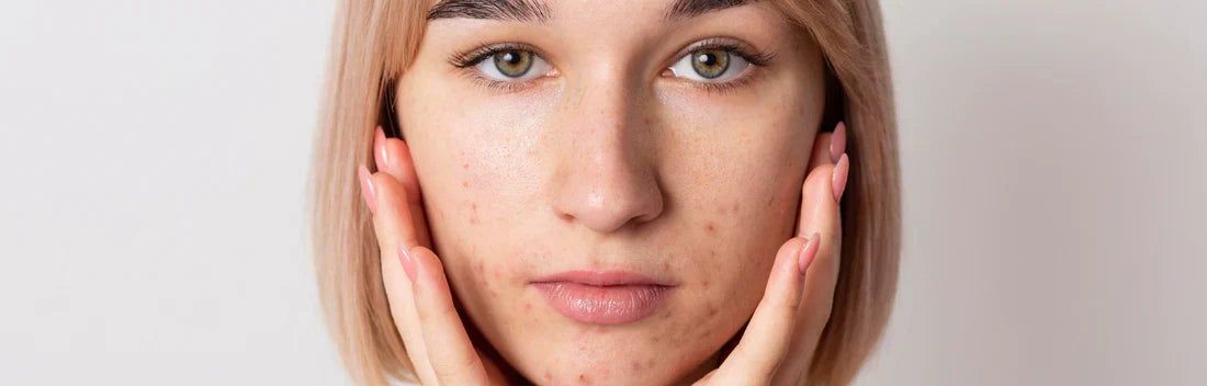 Cuidado facial para piel grasa: cómo reducir el acné y los puntos negros con una rutina eficaz
