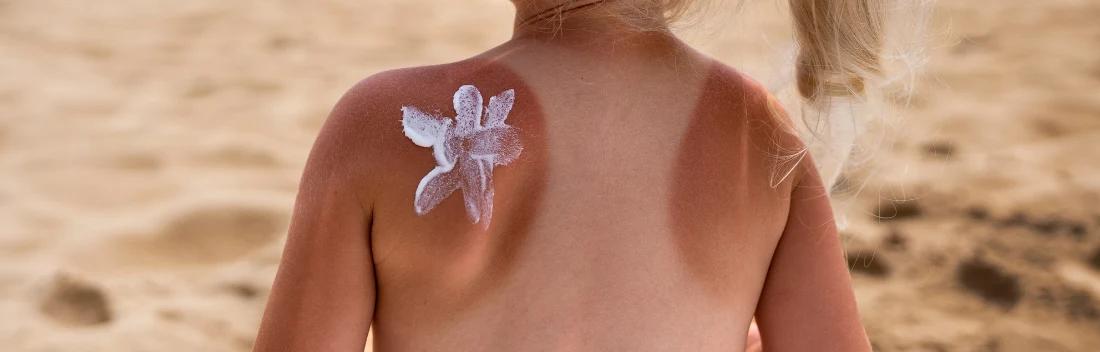 Cómo influyen los fototipos de piel en el bronceado y el riesgo de sufrir quemaduras solares