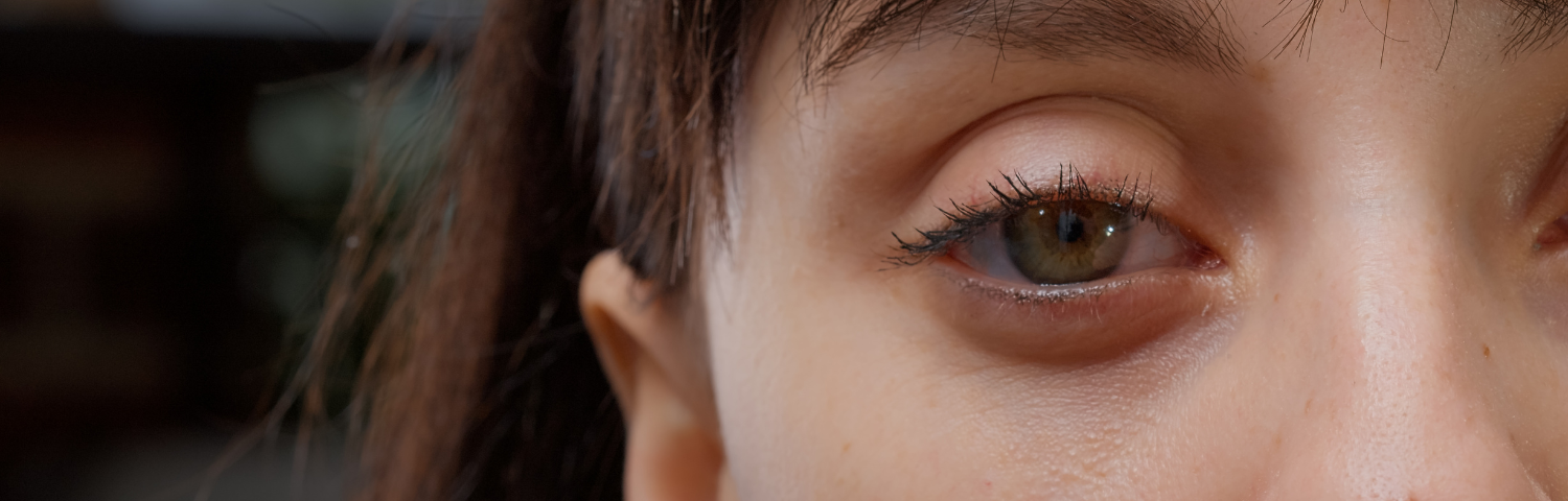 ¿Cómo es la conjuntivitis en bebés y su tratamiento?
