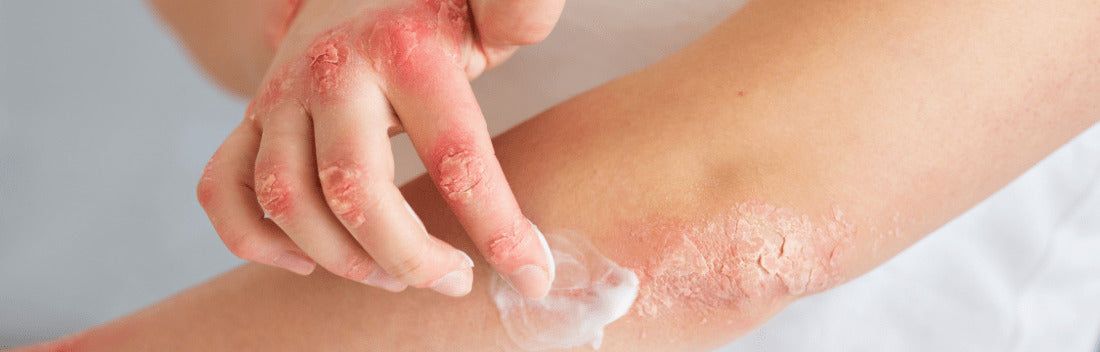 Diferencias entre eczema y psoriasis y cuáles son las mejores cremas para su tratamiento
