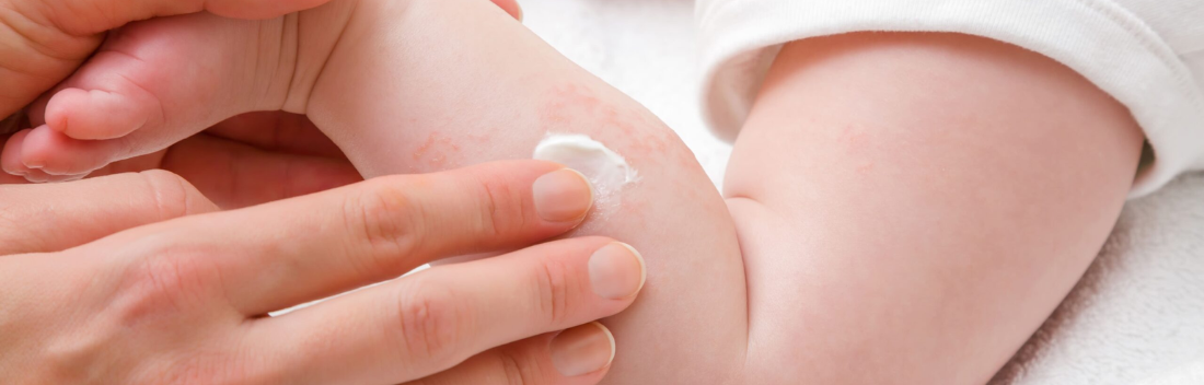 Sudamina en bebés: cremas y tratamiento