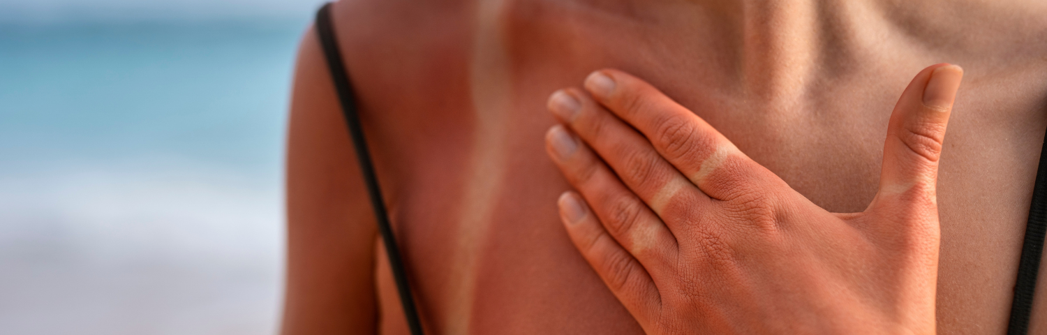 Piel pelada por el sol ¿Qué hacer para prevenirlo?