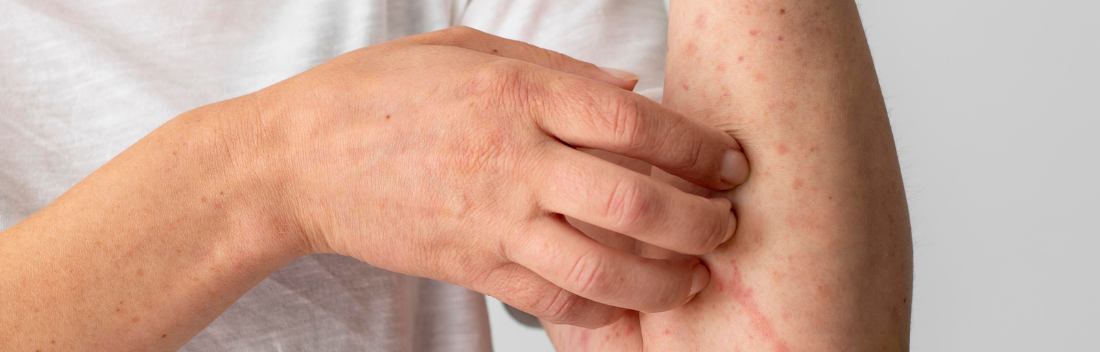 Urticaria en la piel: tipos y las mejores cremas antihistamínicas de farmacia