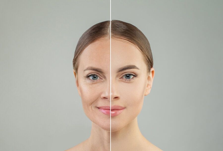 Image showing woman's face before and after medical anti-aging treatments