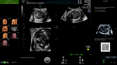 AI Workflow Optimization - GE ultrasound feature