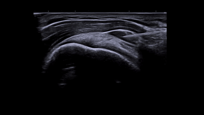 AI Needle Recognition - GE ultrasound feature