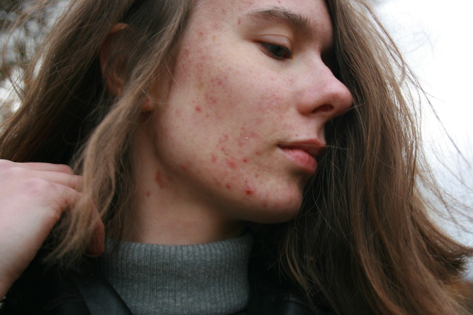 Acne and Diet: The Gut-Skin Connection Your Dermatologist Missed